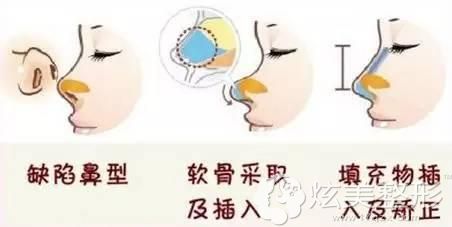 吴铉培院长做隆鼻手术过程 吴铉培院长做隆鼻手术过程