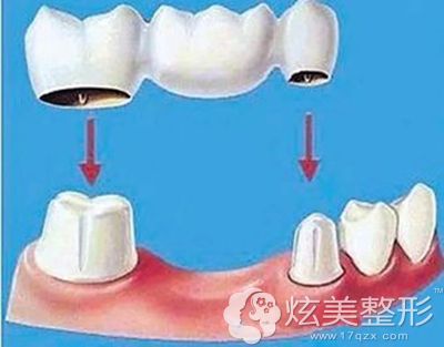 钛合金烤瓷牙手术时需要磨牙 钛合金烤瓷牙手术时需要磨牙