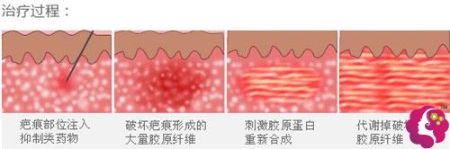 鼻头缩小术后有增生可以手术去除 鼻头缩小术后有增生可以手术去除