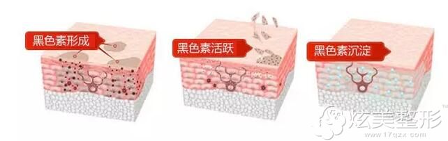 激光去黑眼圈的手术原理 激光去黑眼圈的手术原理