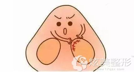 鼻综合采用鼻内切口 鼻综合采用鼻内切口