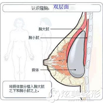 双平面植入假体隆胸简易图 双平面植入假体隆胸简易图