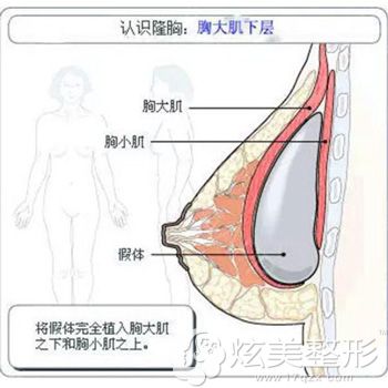 胸大肌下植入假体丰胸效果 胸大肌下植入假体丰胸效果