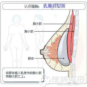 乳腺下植入假体隆胸手术步骤示意图 乳腺下植入假体隆胸手术步骤示意图