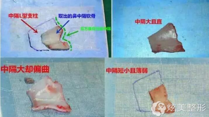 一部分专业医生认为鼻中隔软骨是可以垫鼻尖 一部分专业医生认为鼻中隔软骨是可以垫鼻尖