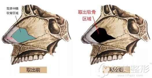 还有一部分医生不建议鼻尖选择鼻中隔软骨 还有一部分医生不建议鼻尖选择鼻中隔软骨
