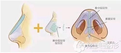 鼻中隔软骨做鼻综合手术原理 鼻中隔软骨做鼻综合手术原理