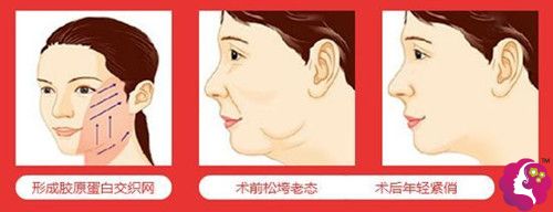 30多岁可以选择埋线提升除皱 30多岁可以选择埋线提升除皱