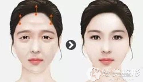 做完无痕提眉术的效果图 做完无痕提眉术的效果图