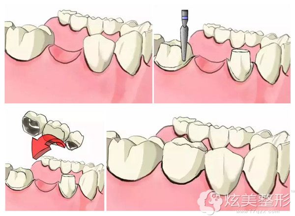 镶牙的过程图解 镶牙的过程图解