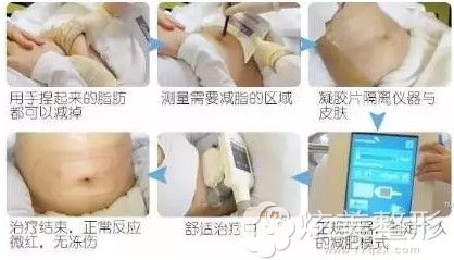 冷冻溶脂过程舒适无切口 冷冻溶脂过程舒适无切口