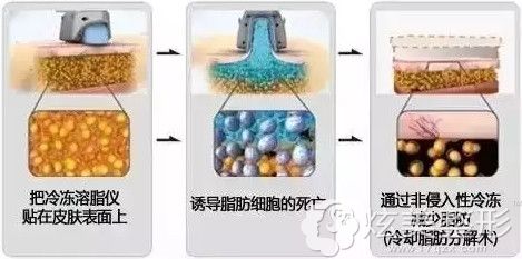 韩国梦线冷冻溶脂过程 韩国梦线冷冻溶脂过程