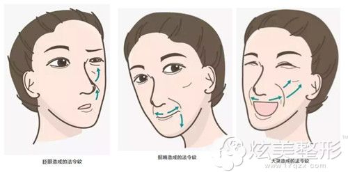 夸张的表情很容易让法令纹越来越深 夸张的表情很容易让法令纹越来越深