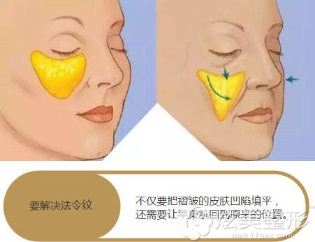 苹果肌下垂让法令纹更加明显 苹果肌下垂让法令纹更加明显