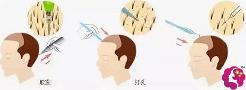 金炳模院长做毛发移植手术 金炳模院长做毛发移植手术