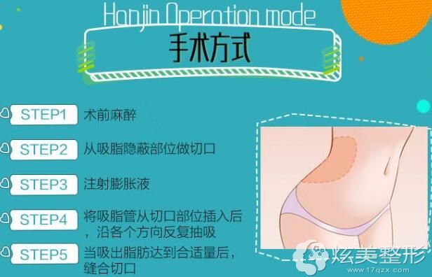 腰腹环吸的手术过程 腰腹环吸的手术过程