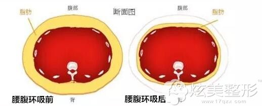 腰腹环吸前期有肿胀阶段,3个月左右能看到明显变细 腰腹环吸前期有肿胀阶段,3个月左右能看到明显变细