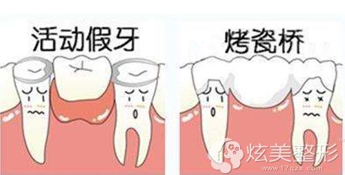 镶牙的两种假牙类型 镶牙的两种假牙类型