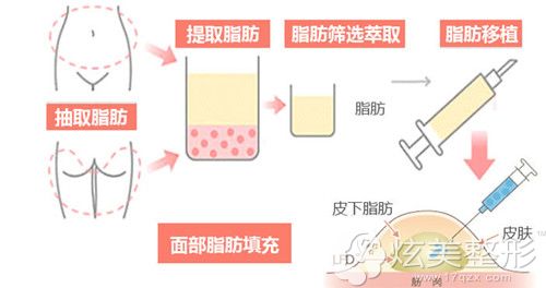 广州健丽美诗沁整形医生陈鲁尼做脂肪填充过程 广州健丽美诗沁整形医生陈鲁尼做脂肪填充过程