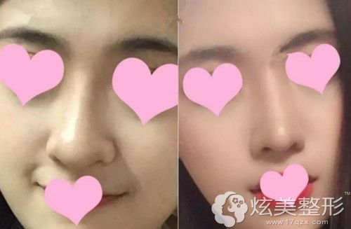 内切缩鼻翼术后效果明显 内切缩鼻翼术后效果明显