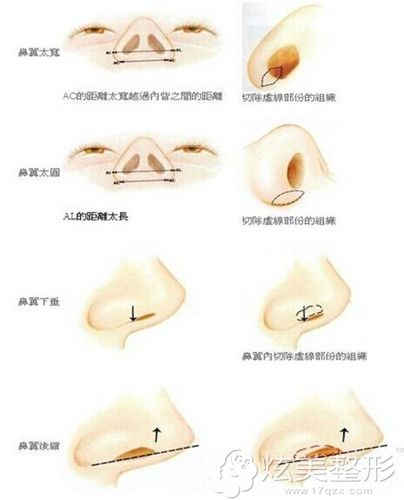 做内切缩鼻翼手术过程 做内切缩鼻翼手术过程