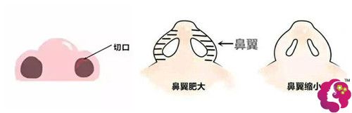 内切缩鼻翼的切口 内切缩鼻翼的切口