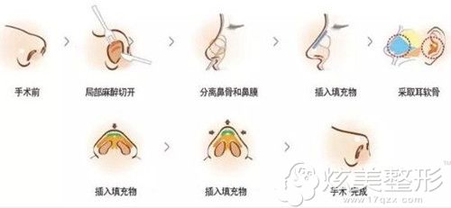 崔民院长做自体软骨隆鼻手术过程 崔民院长做自体软骨隆鼻手术过程