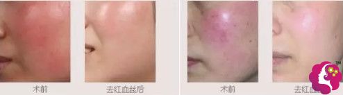 脉冲染料激光去红血丝案例 脉冲染料激光去红血丝案例