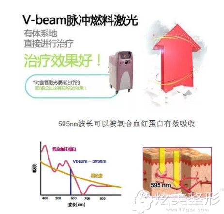 脉冲染料激光治疗敏感肌的红血丝 脉冲染料激光治疗敏感肌的红血丝