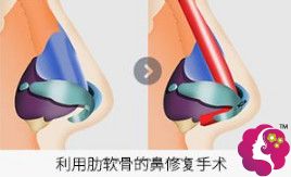 黄院长做隆鼻失败修复手术用自体软骨 黄院长做隆鼻失败修复手术用自体软骨