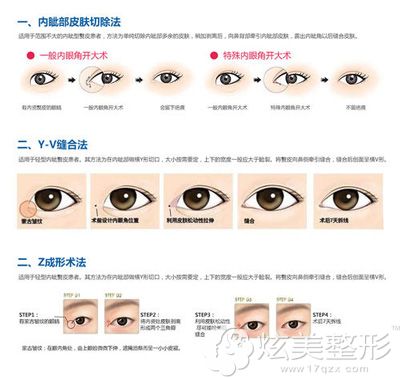 改善内眦赘皮的手术方式 改善内眦赘皮的手术方式