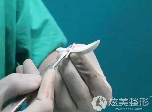 鼻假体雕刻原因造成的外露 鼻假体雕刻原因造成的外露