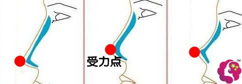 柳叶形假体需要做好鼻尖支撑 柳叶形假体需要做好鼻尖支撑