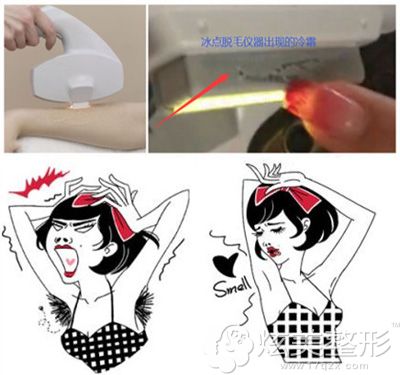 使用冰点脱腋毛术前术后对比效果 使用冰点脱腋毛术前术后对比效果