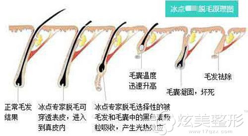 冰点脱毛的治疗原理 冰点脱毛的治疗原理