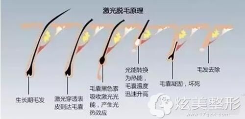 激光脱毛原理 激光脱毛原理