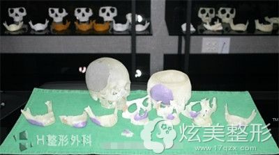 白汀恒院长擅长做面部轮廓整形手术 白汀恒院长擅长做面部轮廓整形手术