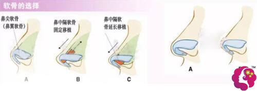 孙磊医生做自体软骨隆鼻手术 孙磊医生做自体软骨隆鼻手术