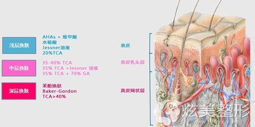 水杨酸不同浓度祛痘原理 水杨酸不同浓度祛痘原理