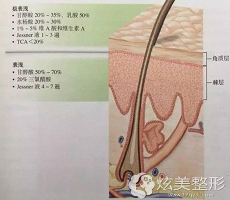 果酸焕肤不同浓度祛痘原理 果酸焕肤不同浓度祛痘原理