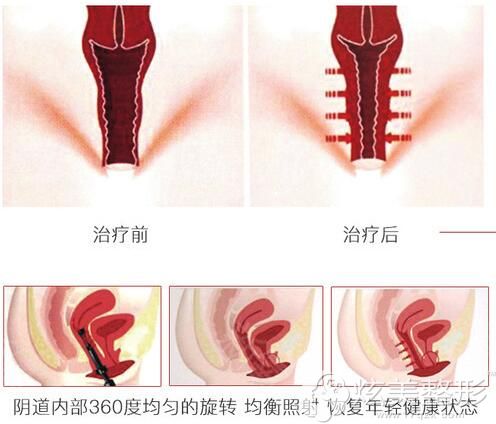 超声提升阴道缩紧手术原理 超声提升阴道缩紧手术原理
