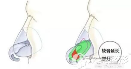 自体软骨延长鼻中隔整形 自体软骨延长鼻中隔整形