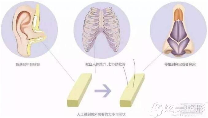 短鼻延长建议选择鼻中隔或肋软骨 短鼻延长建议选择鼻中隔或肋软骨
