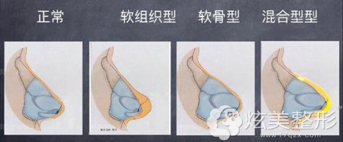 ��ͬ���͵ı�ͷ�ʴ�