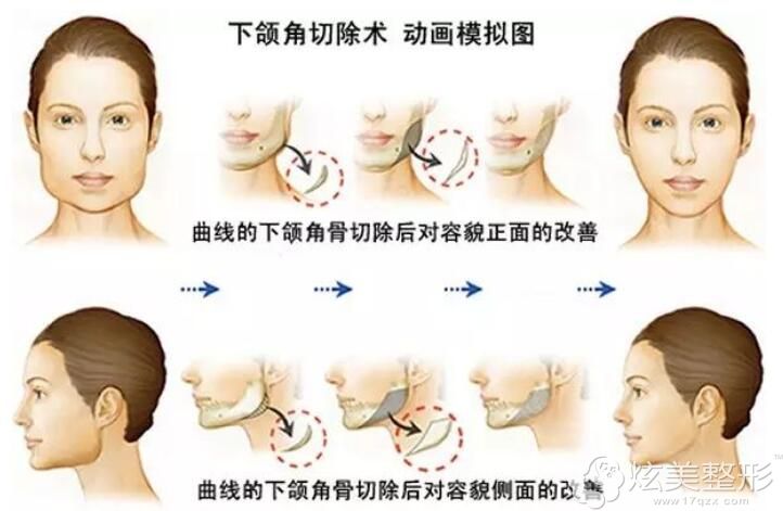 长曲线下颌角对面部的影响 长曲线下颌角对面部的影响
