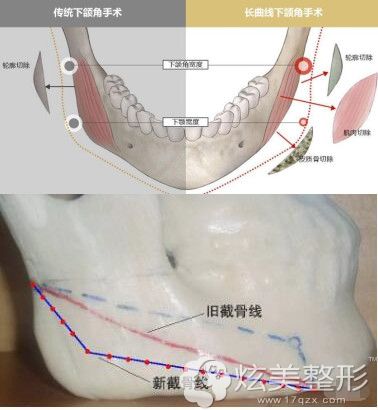 传统下颌角和长曲线的区别 传统下颌角和长曲线的区别