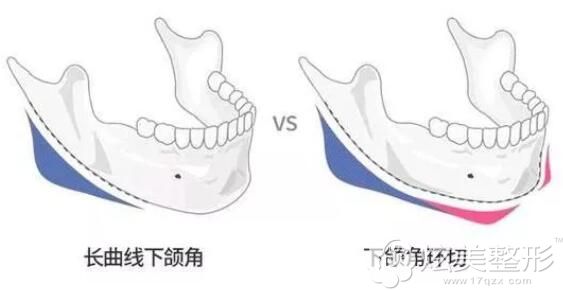 长曲线下颌角和下颌角环切的区别 长曲线下颌角和下颌角环切的区别