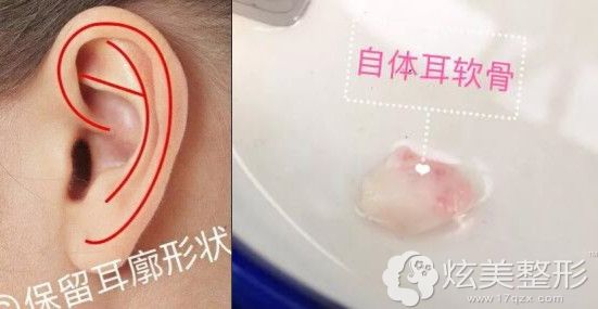 取耳软骨隆鼻耳朵不会变形塌陷 取耳软骨隆鼻耳朵不会变形塌陷