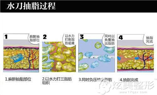 采用水动力吸脂的手术原理 采用水动力吸脂的手术原理