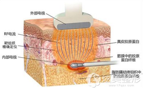 射频溶脂简易手术图 射频溶脂简易手术图